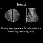 Breast Adapted for Text by Ioannis "Johnny" Vlahos PhD